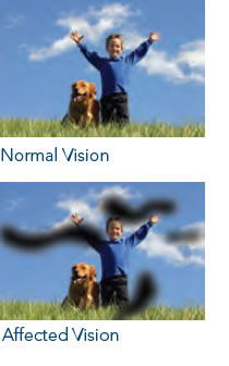 diabetic-retinopathy