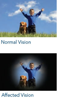 glaucoma